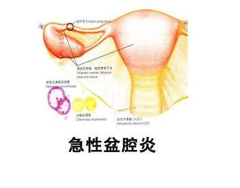 盆腔炎的症状是什么